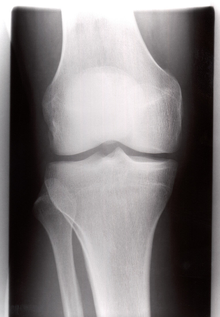 Healthy knee, X-ray