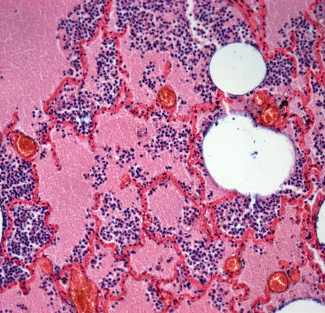 Pneumococcal pneumonia, light micrograph