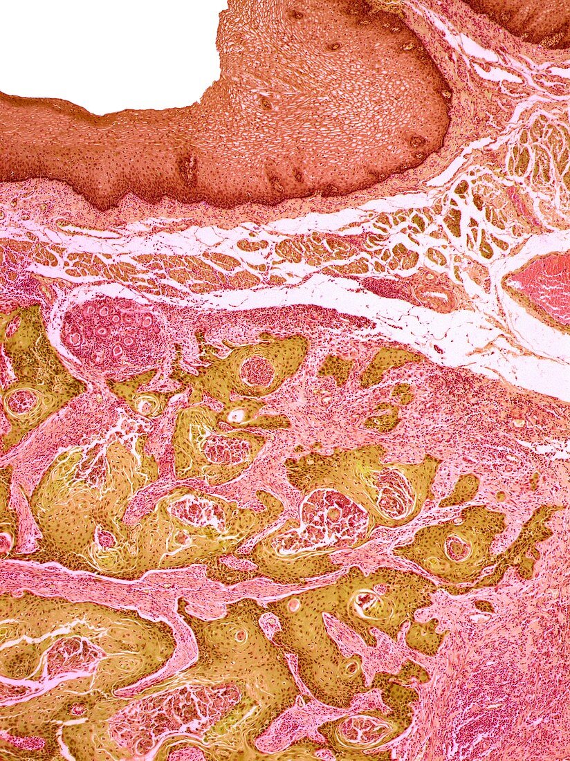Oesophageal cancer, light micrograph