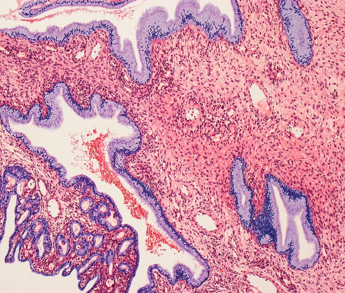 Nasal polyp, light micrograph