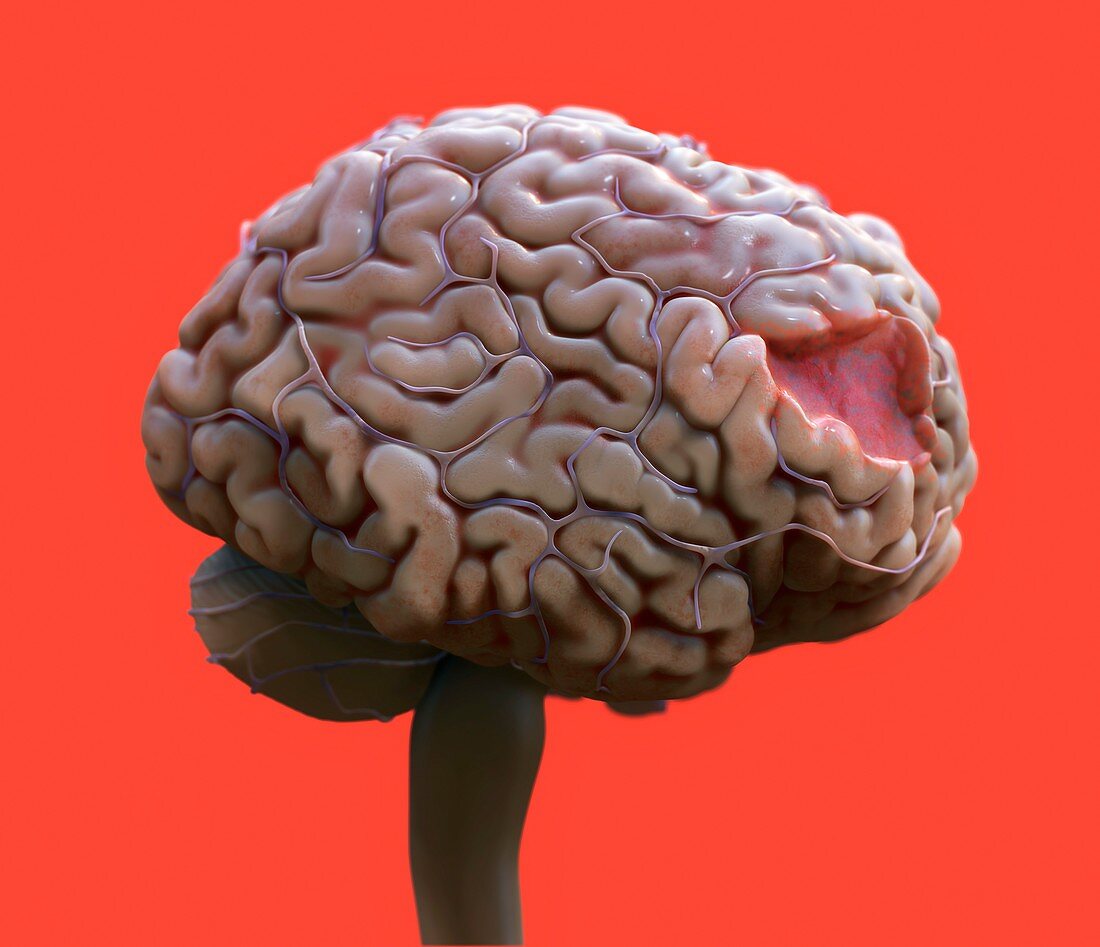 Brain damage, illustration