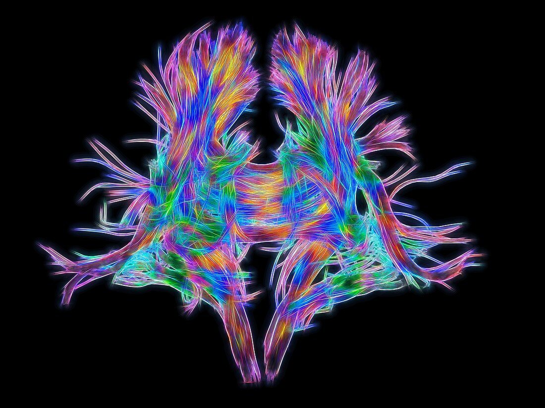 White matter fibres of the human brain, DSI scan