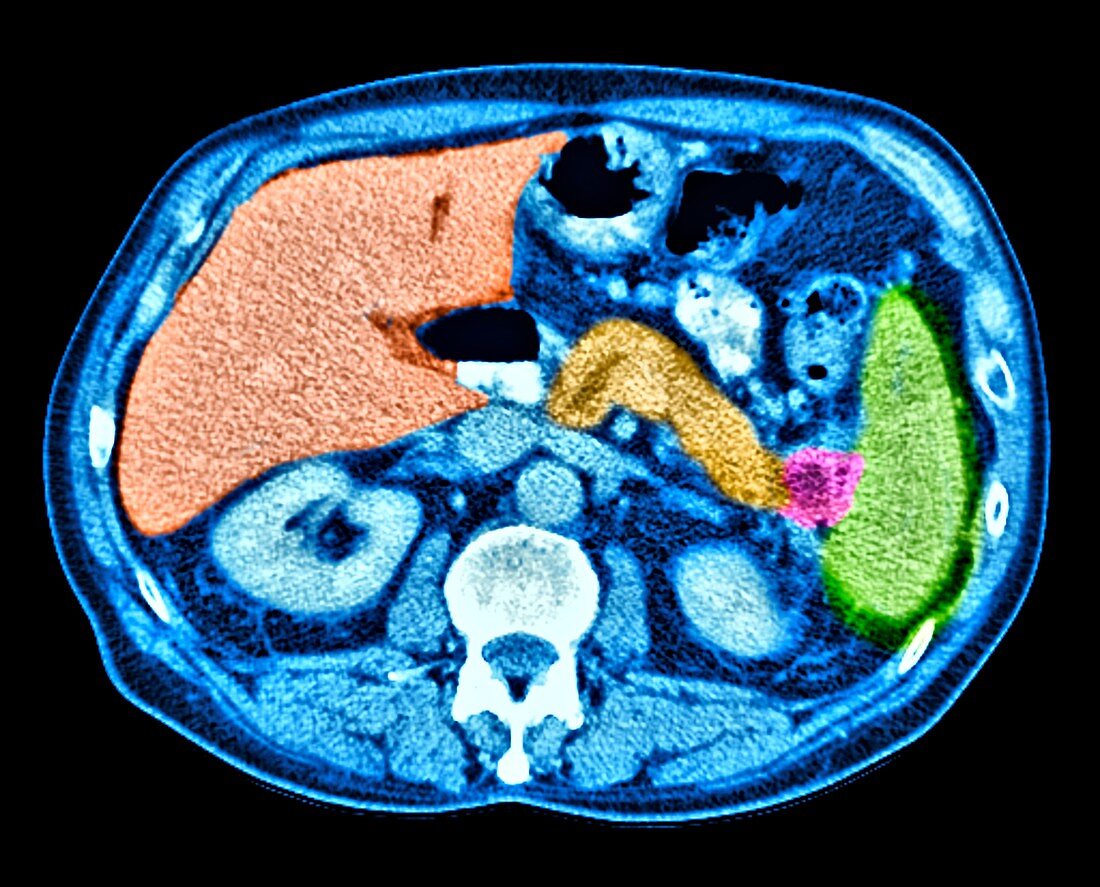 Pancreatic cancer, CT scan