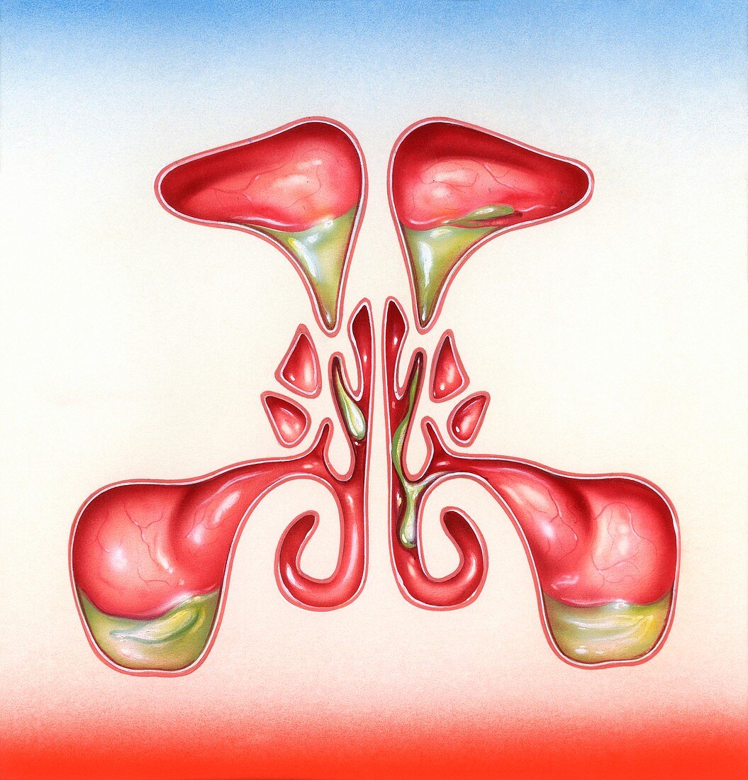 Sinusitis, illustration