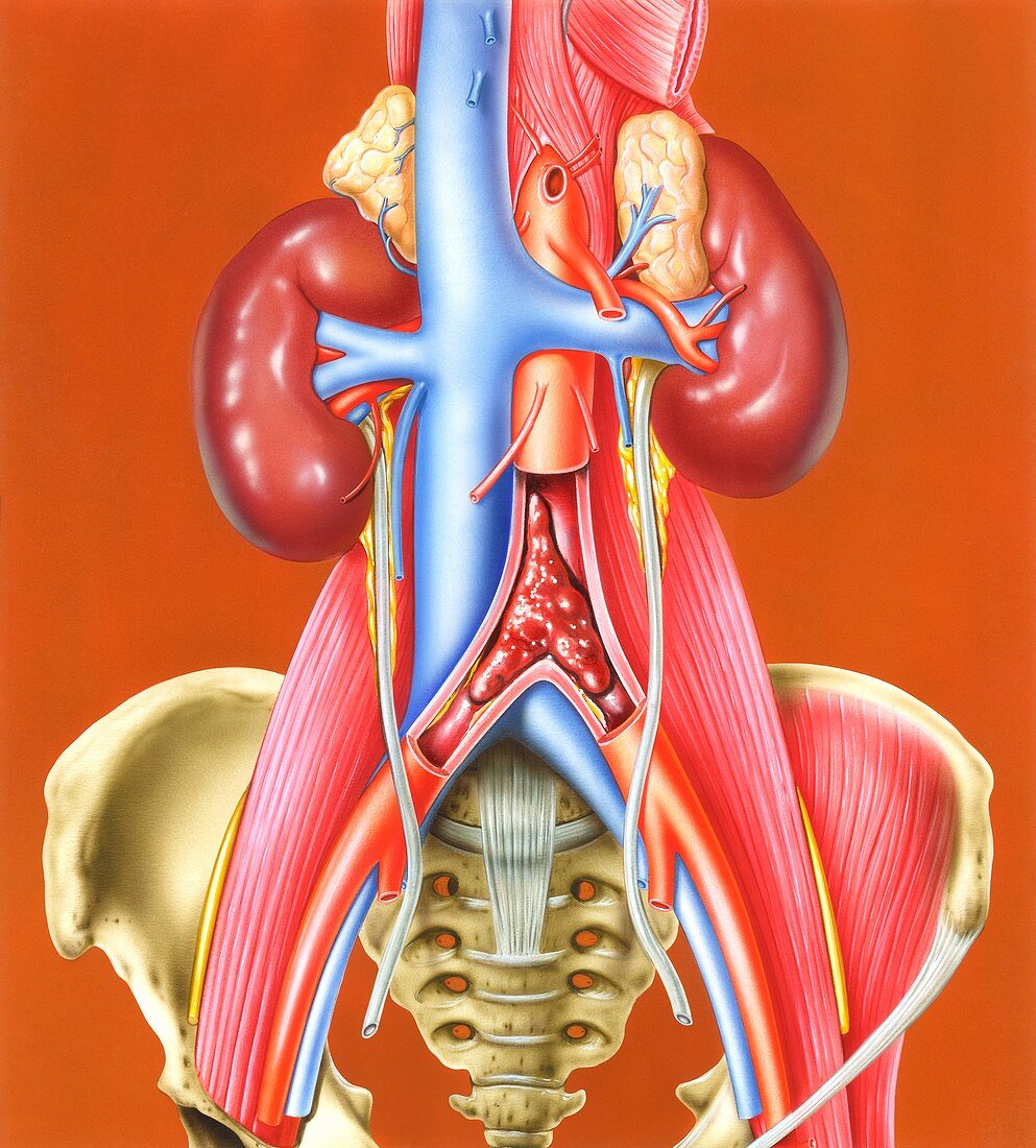 Saddle embolus at aortic bifurcation, illustration
