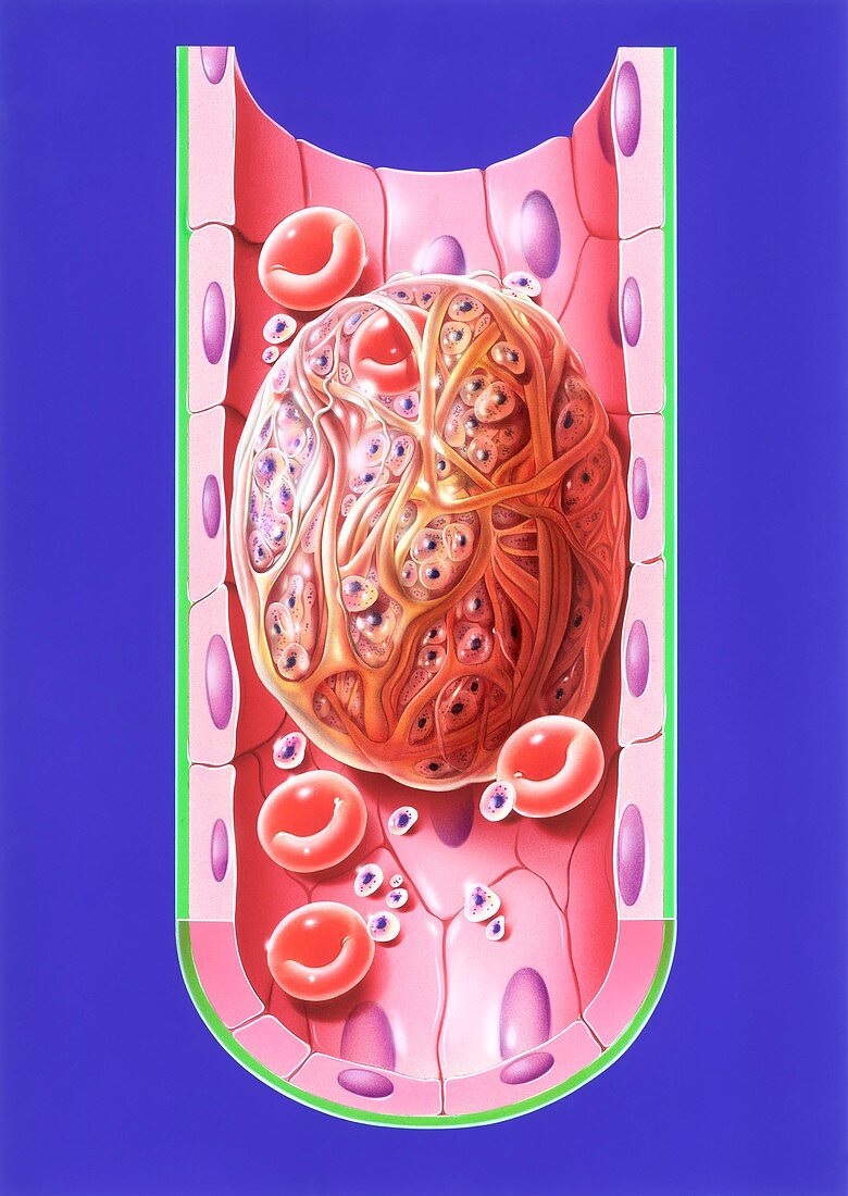 Thrombus in blood vessel, illustration