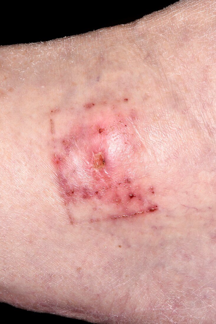 Allergic reaction to wound dressing