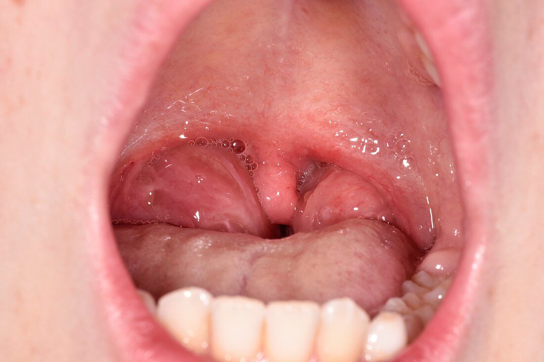 Tonsillitis in a child