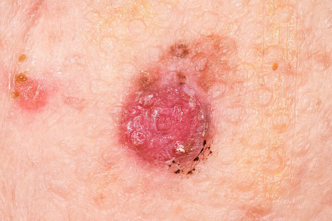 Ulcerated malignant melanoma