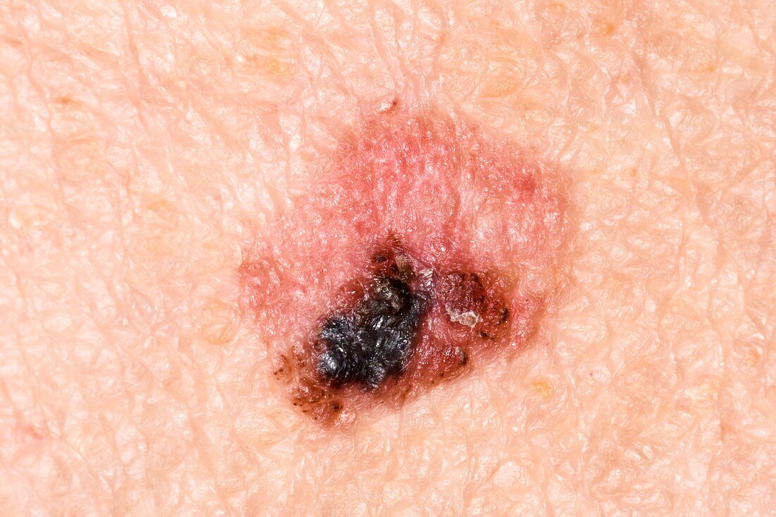 Malignant melanoma