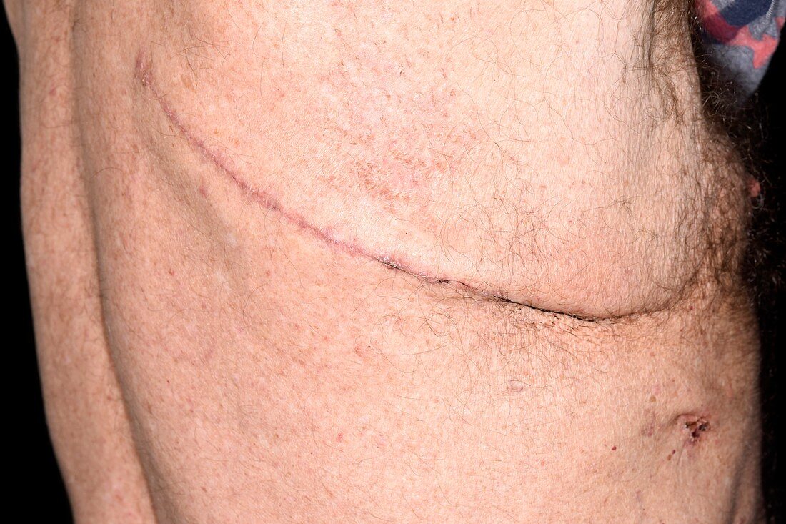 Lung cancer surgery scar
