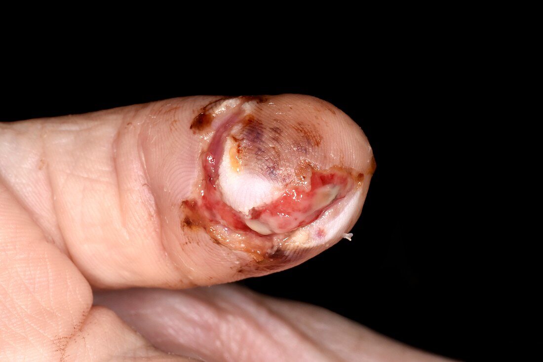 Crushed finger