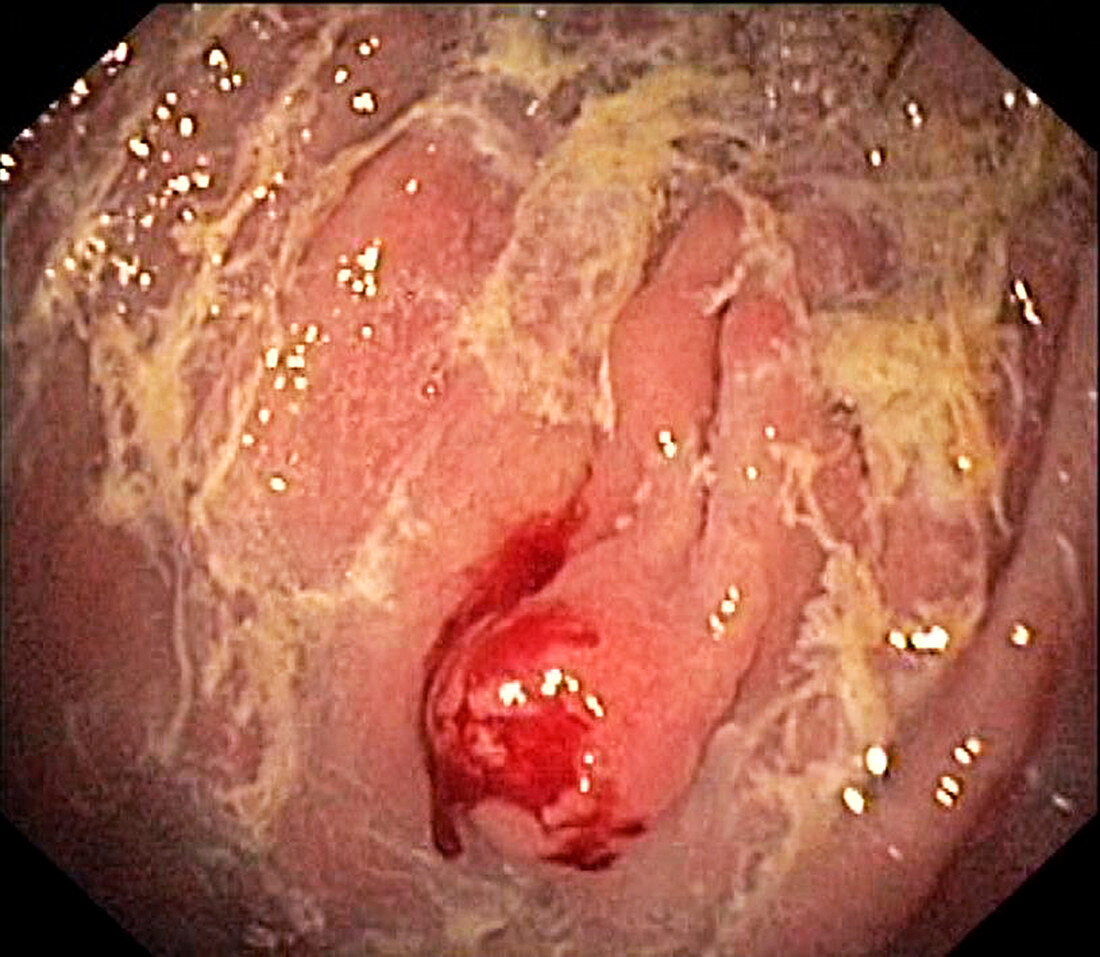 Atrophic gastritis and tumour, endoscope view