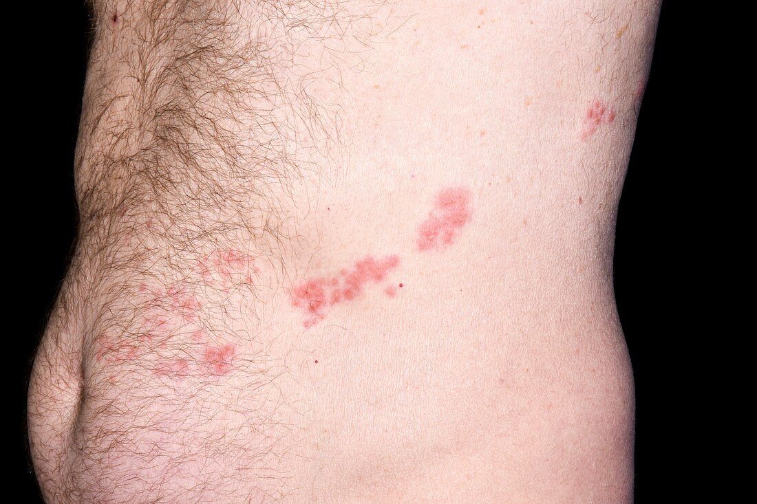 Shingles rash