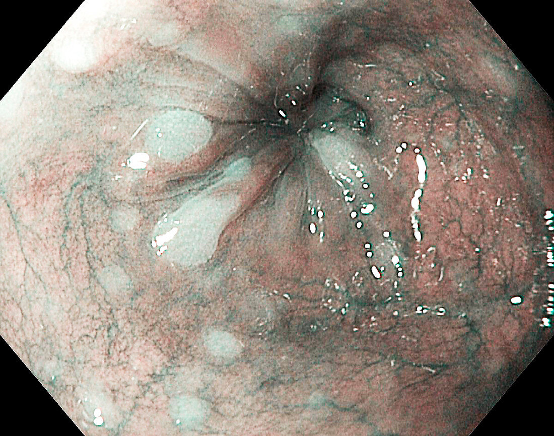 Glycogenic acanthosis of the oesophagus, endoscope view
