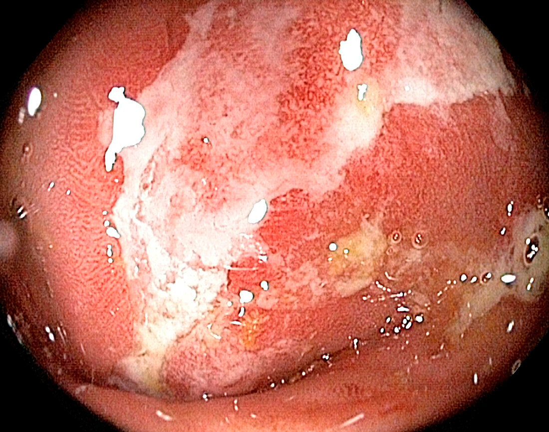 Rectum in Crohn's disease, endoscope view