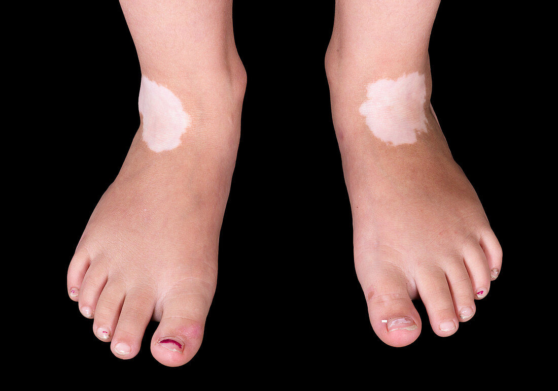 Vitiligo skin condition