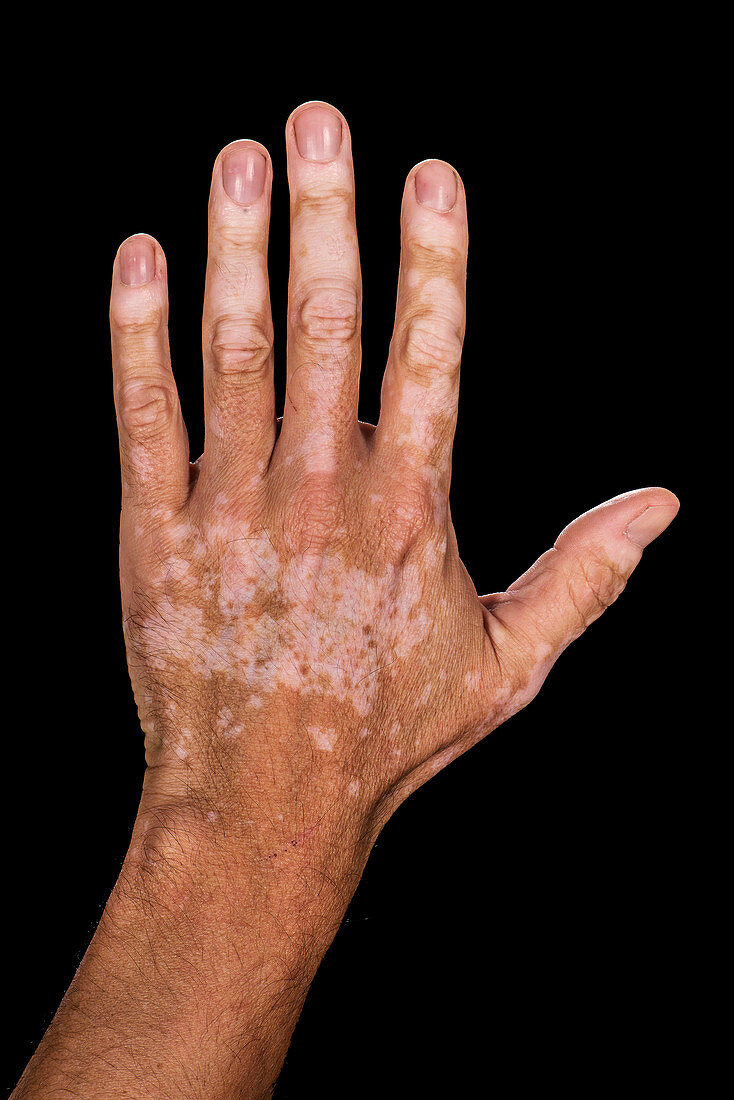 Vitiligo skin condition