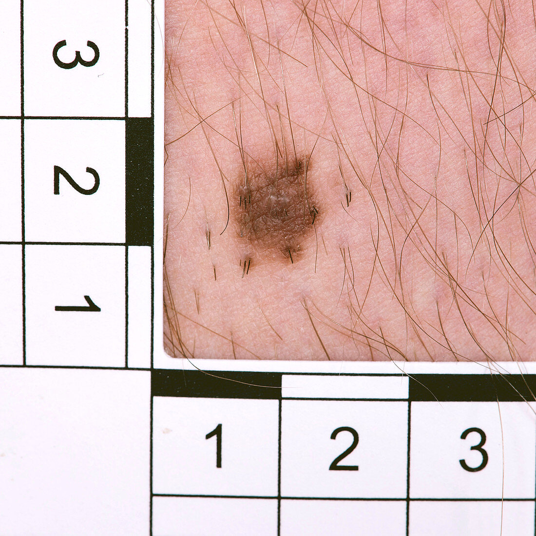 Mole diagnosis