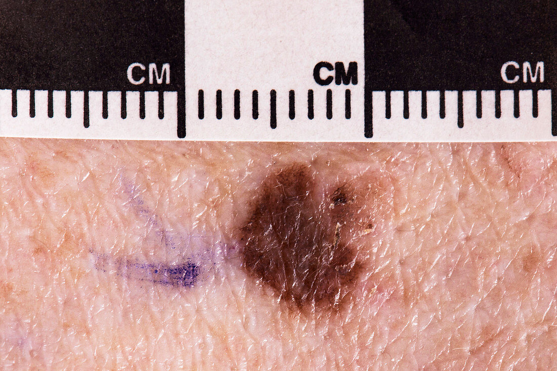 Mole diagnosis