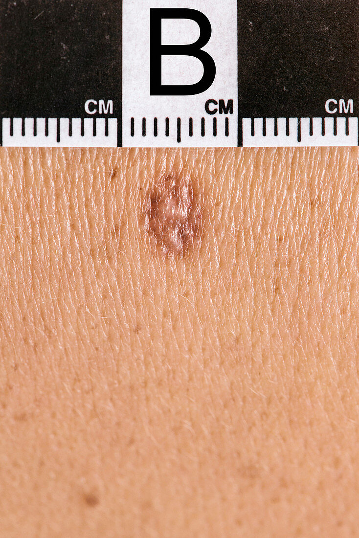 Dermatofibroma diagnosis