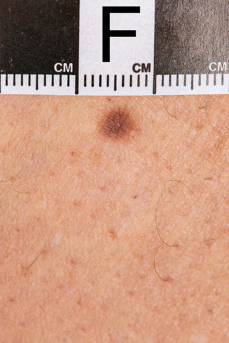 Dermatofibroma diagnosis