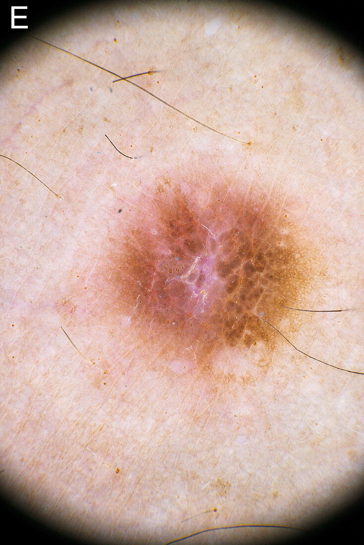 Dermatofibroma diagnosis, dermascope image