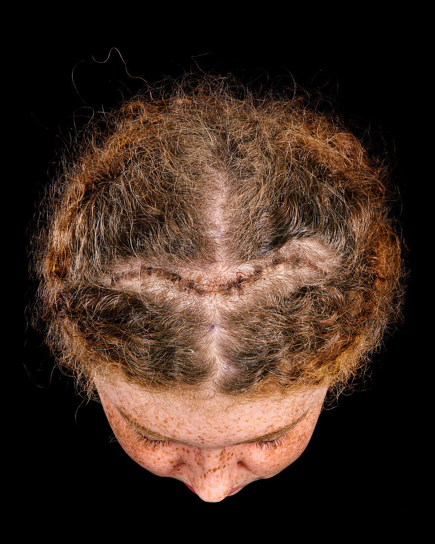 Post-operative cranioplasty scar