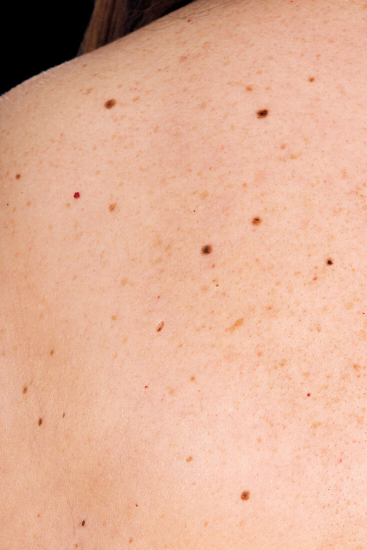 Atypical moles on the back