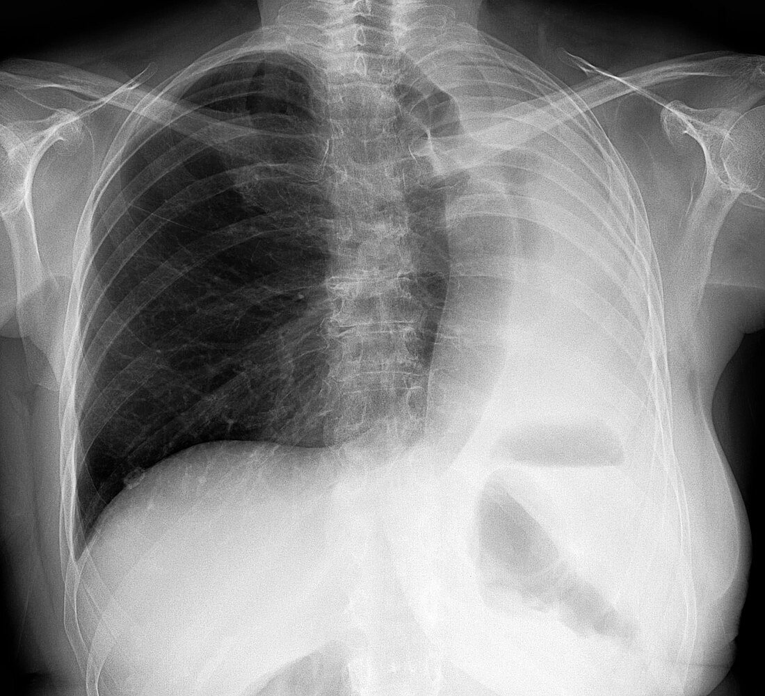 Left pneumonectomy, X-ray