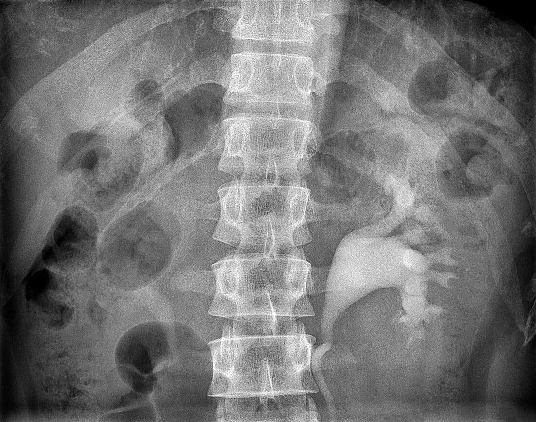 Kidney and obstructed ureter, X-ray