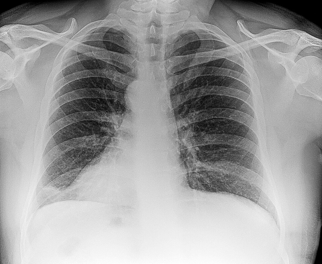 Reversed heart position, X-ray