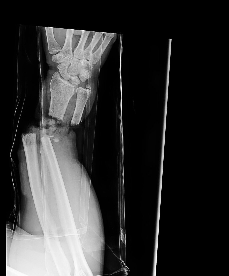 Hand amputation injury, X-ray