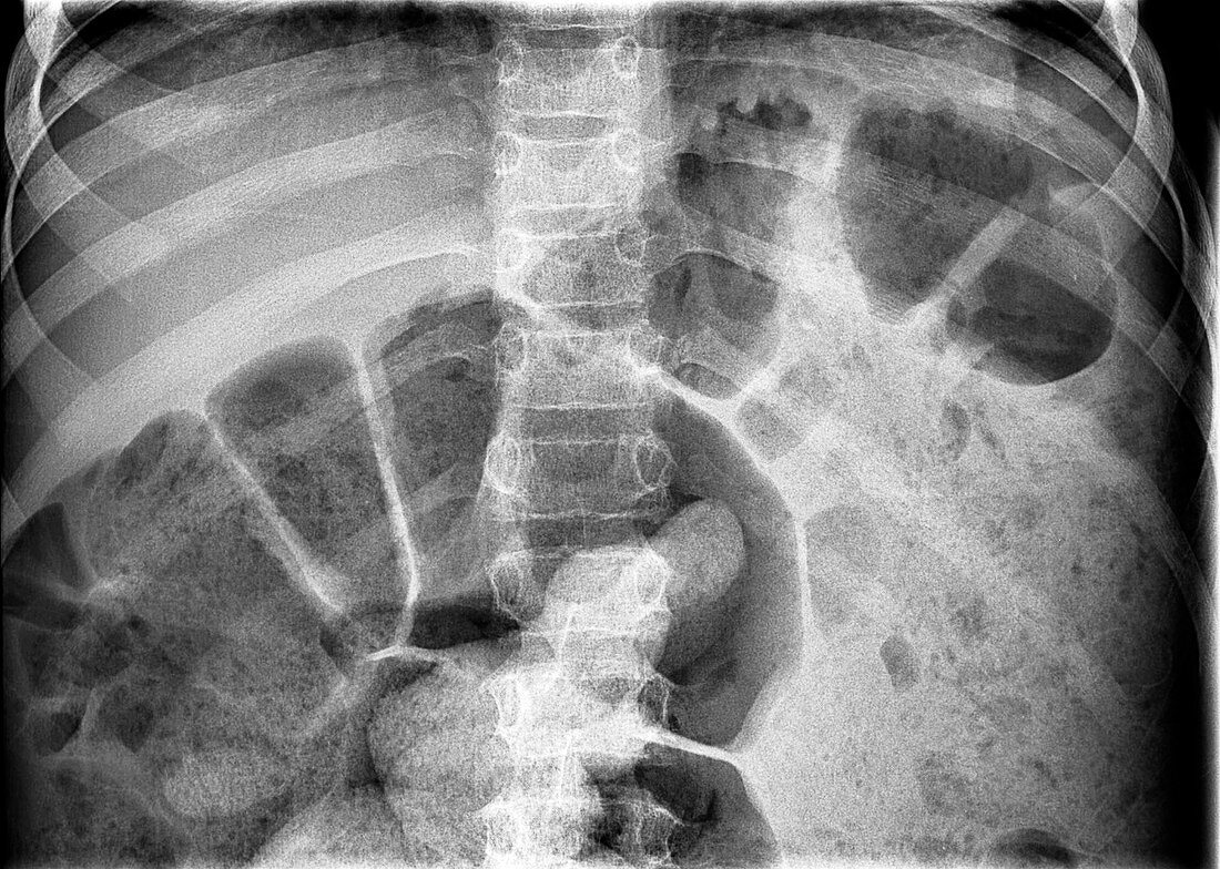 Bowel obstruction, X-ray