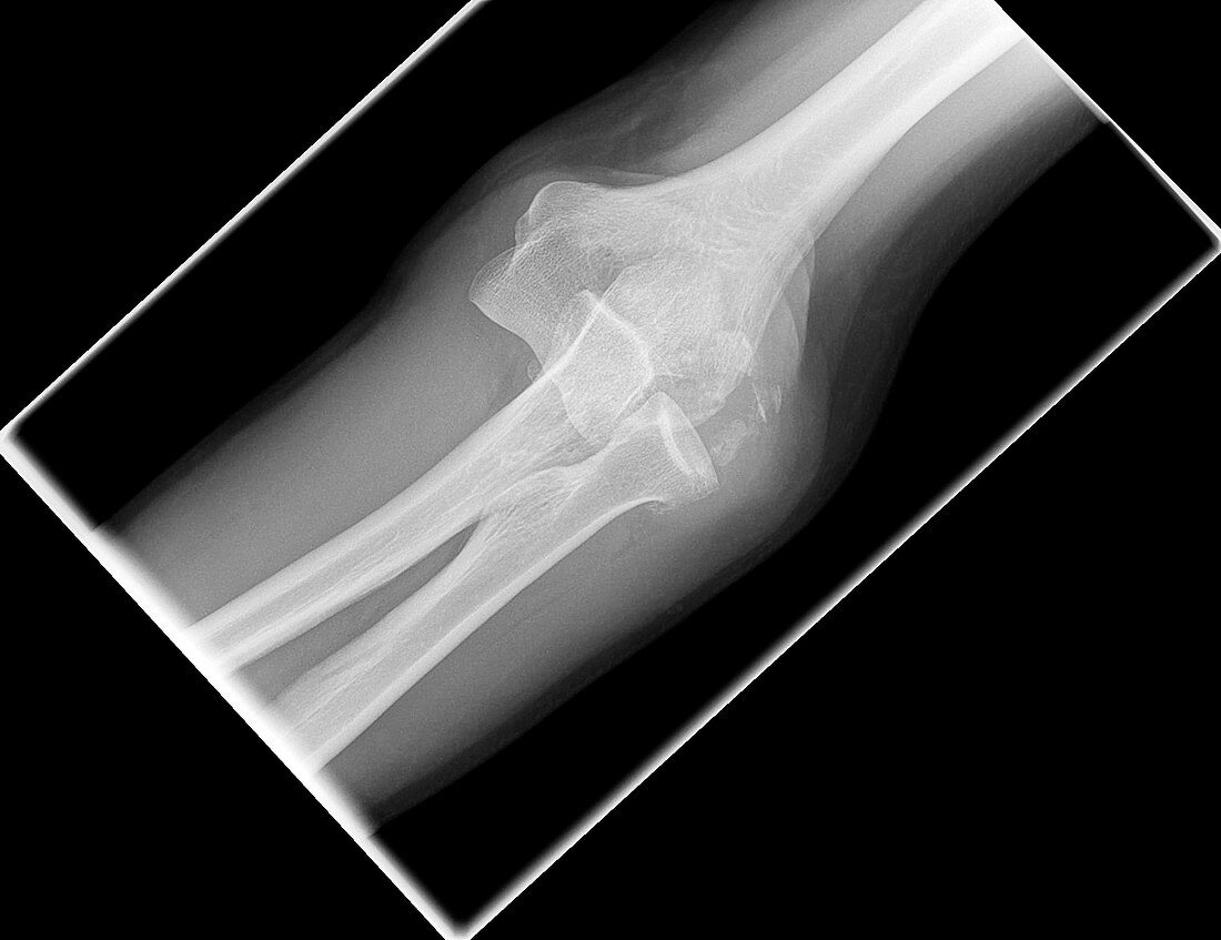 Dislocated elbow, X-ray