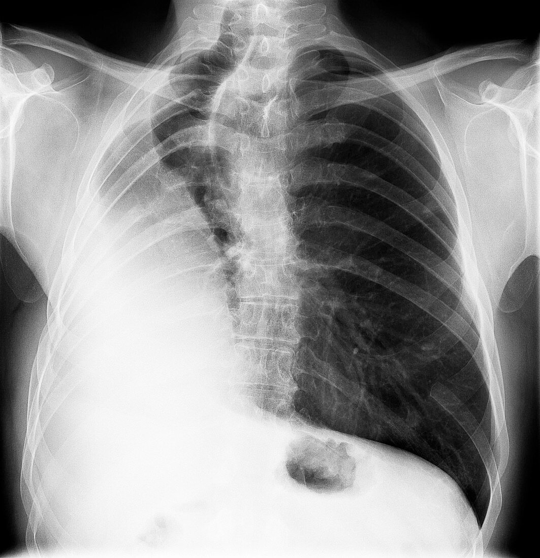 Right pneumonectomy, X-ray