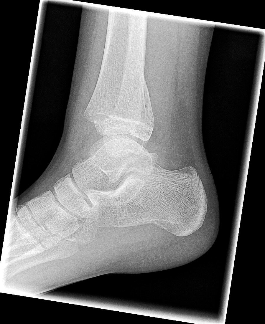 Salter Harris ankle fracture, X-ray