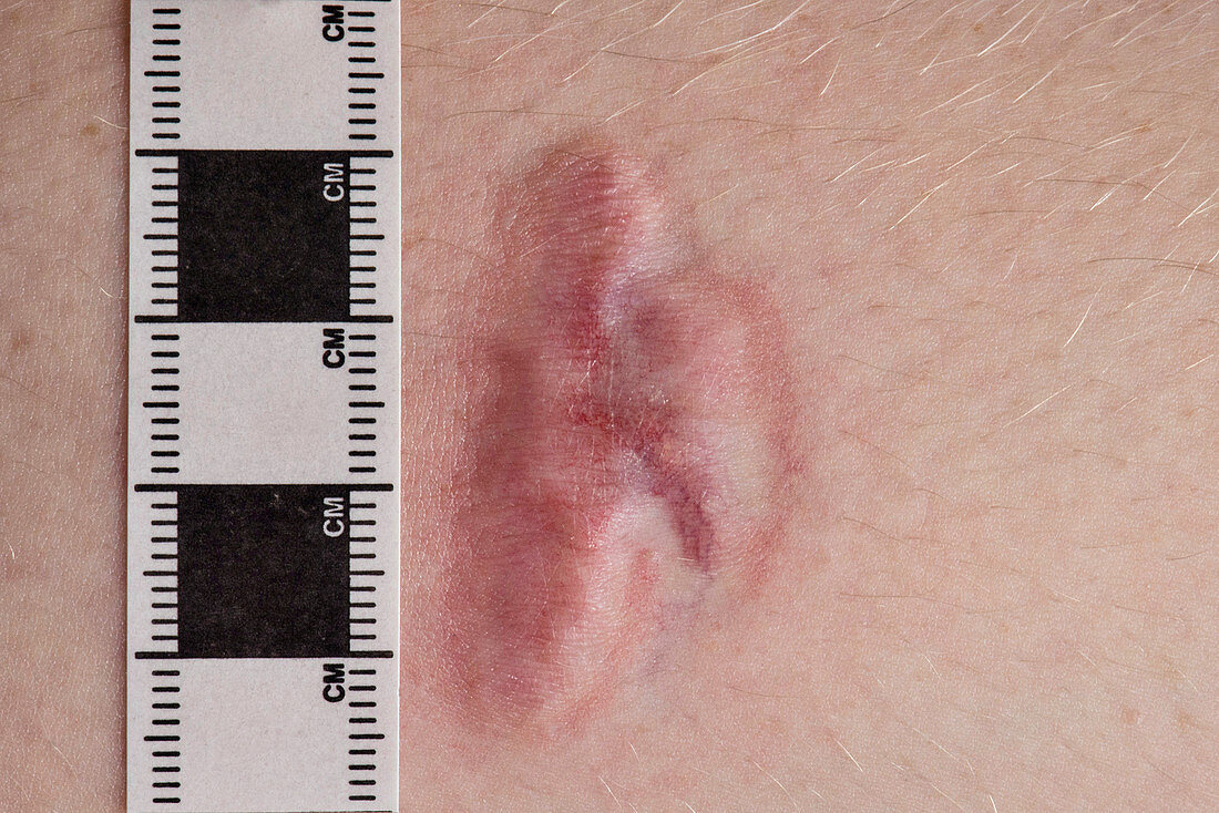 Burns scar