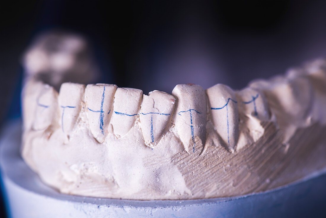 Dental prosthesis with markings