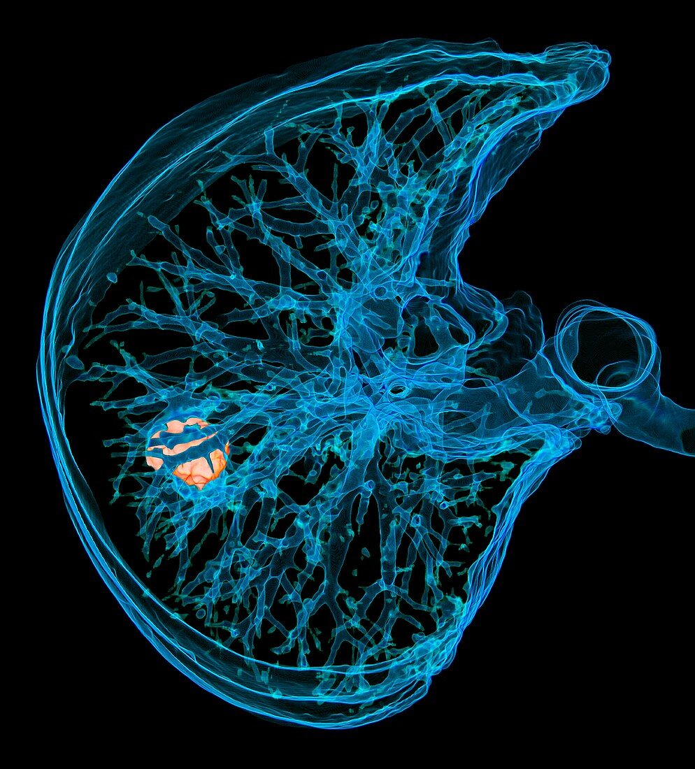 Lung cancer, 3D CT scan