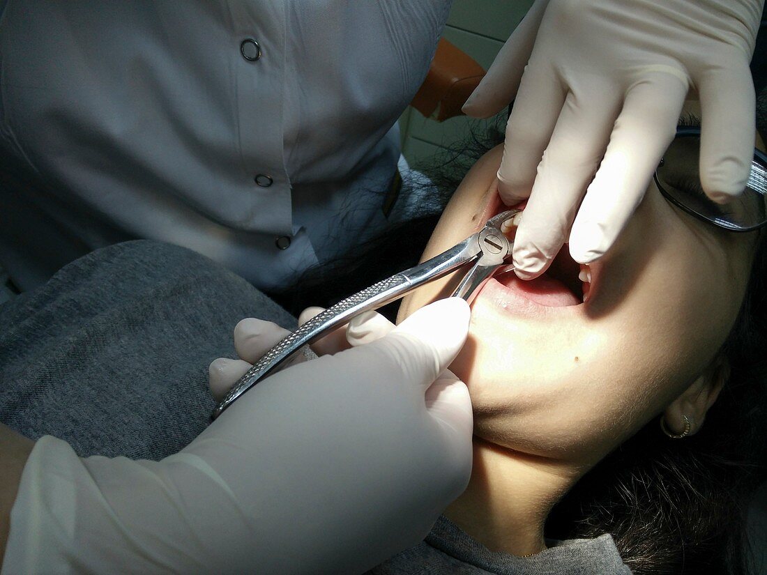 Dentist extracting a tooth