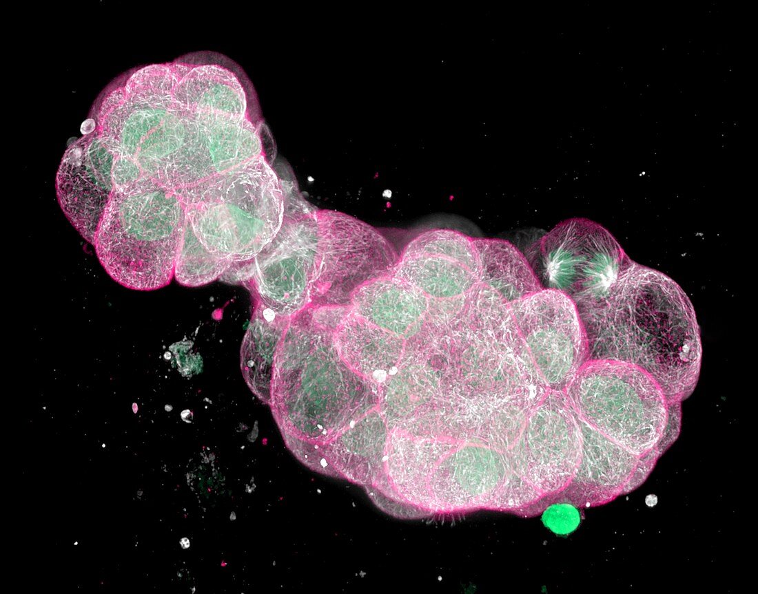 Colon cancer cells, fluorescence micrograph