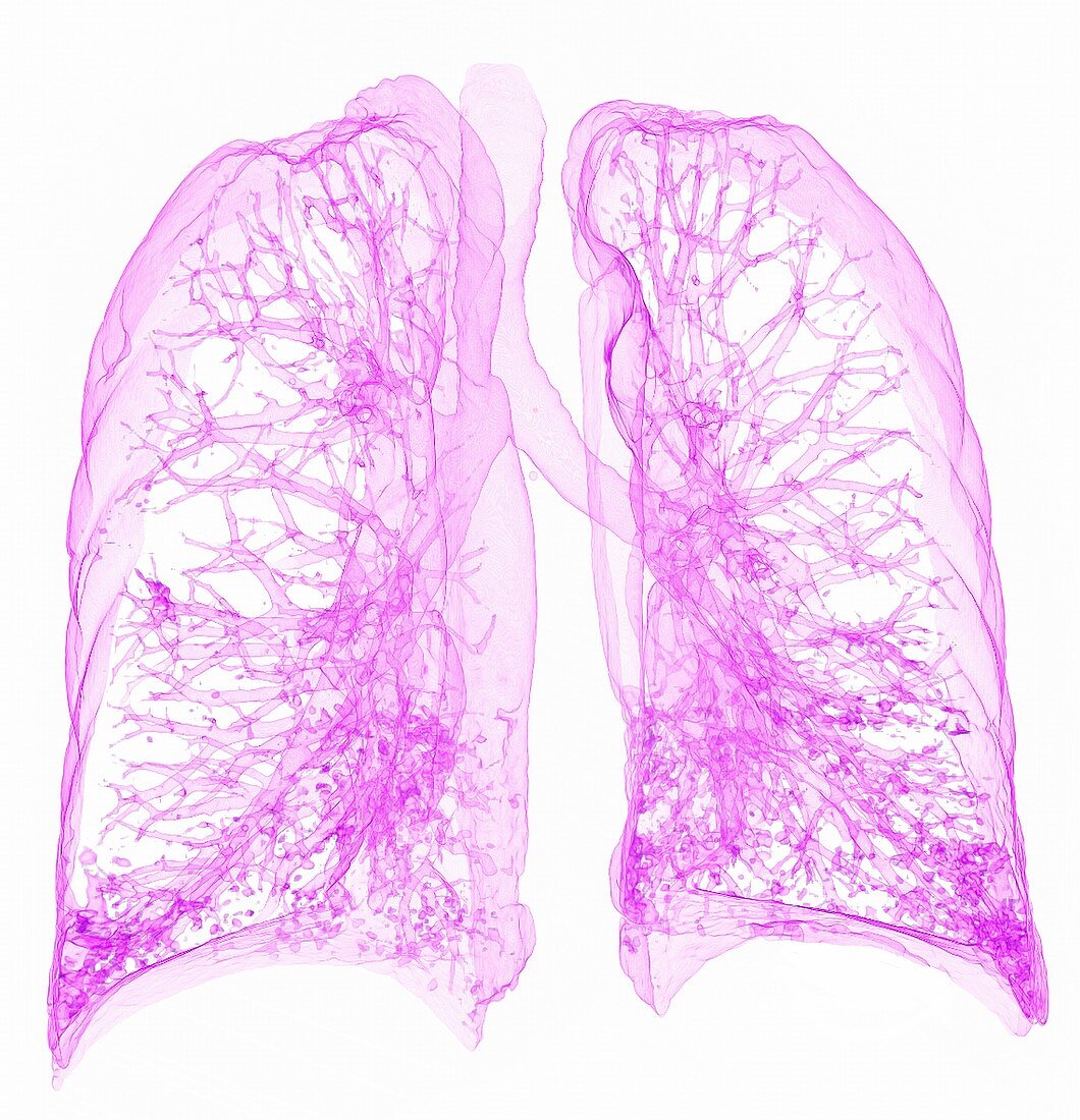 Miliary tuberculosis, 3D CT scan