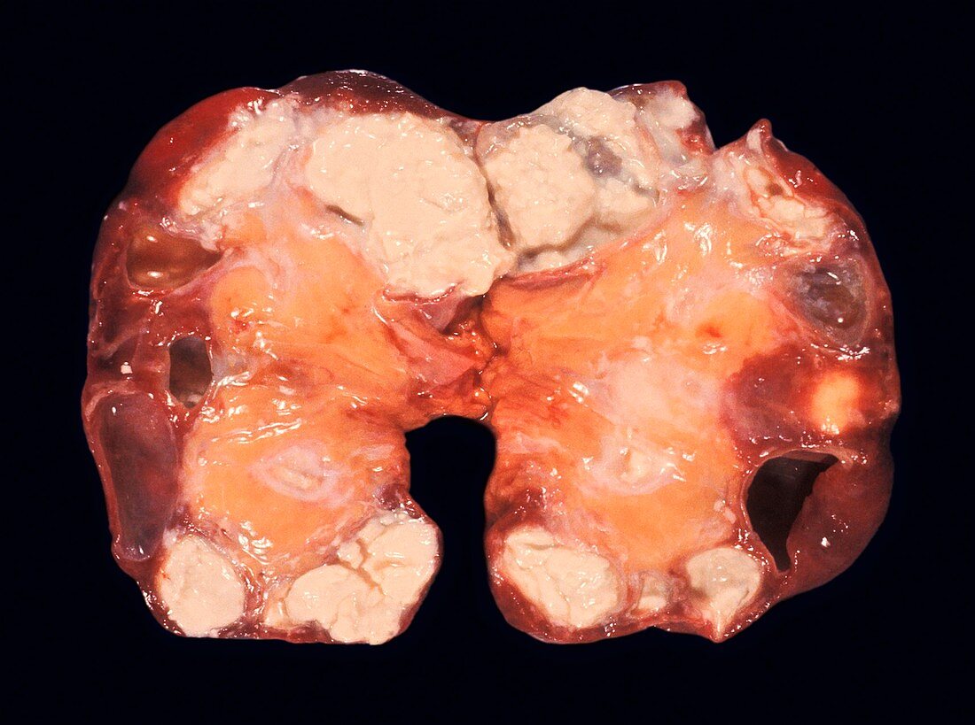 Diseased kidney