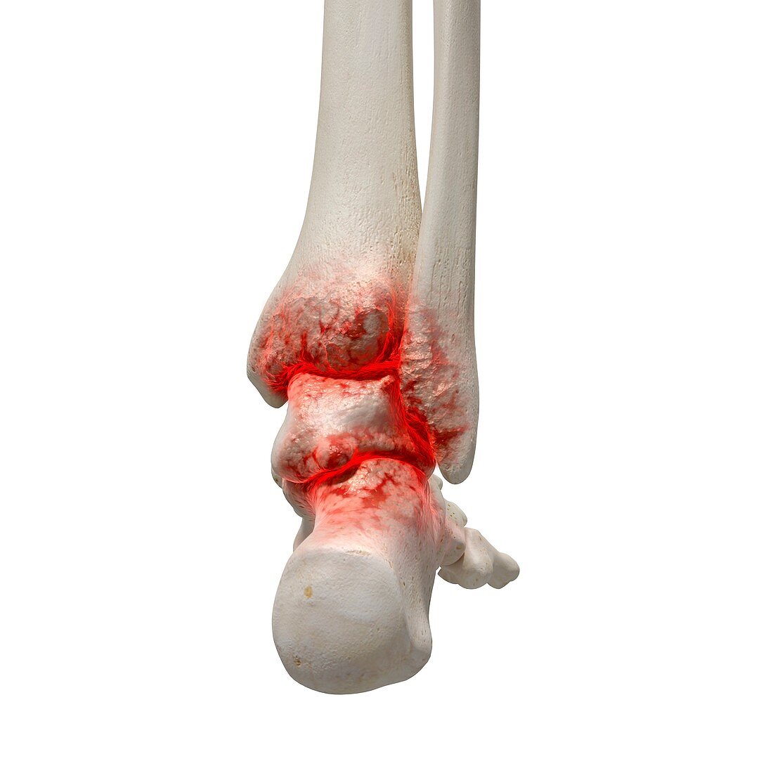 Arthritis in the ankle, illustration