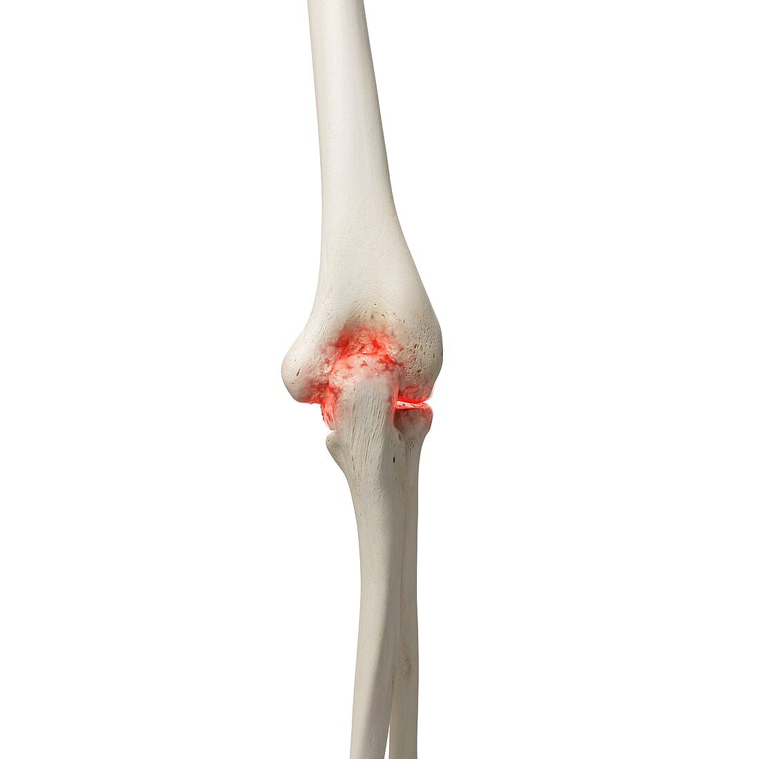 Arthritis in the elbow, illustration