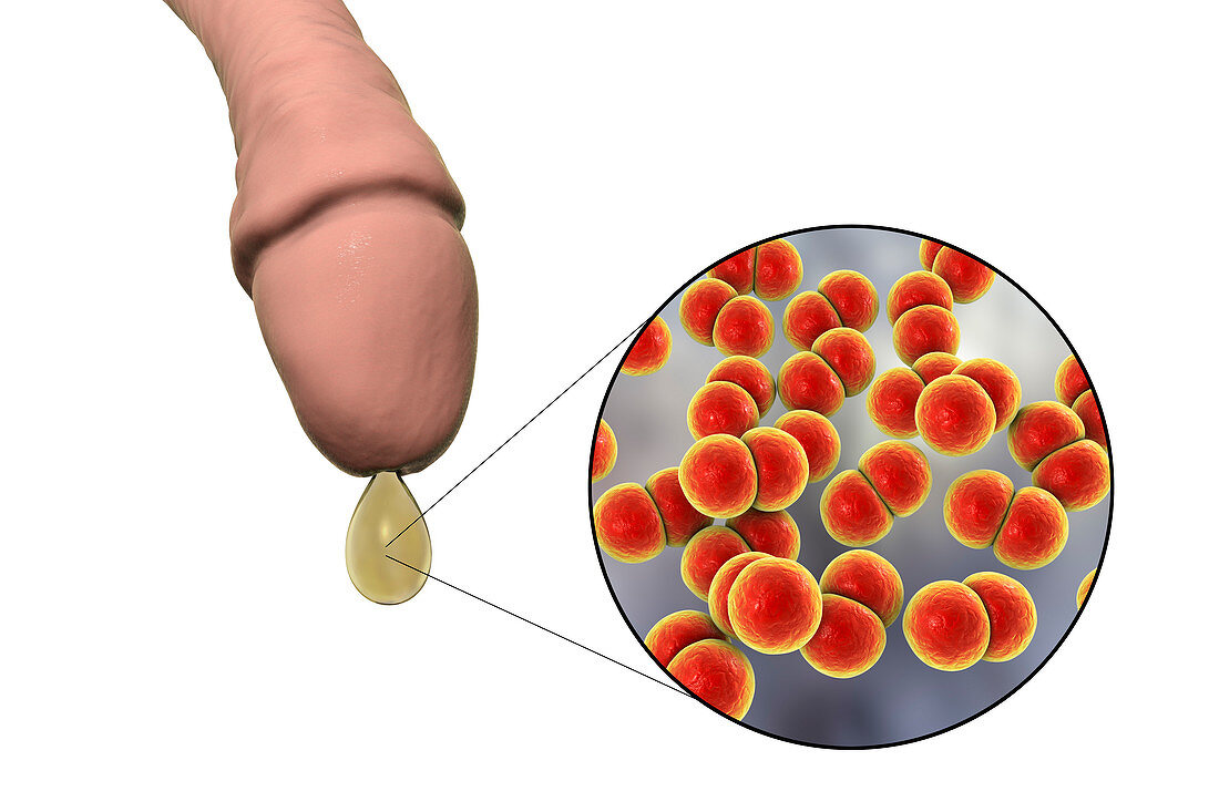 Gonorrhoea infection, illustration
