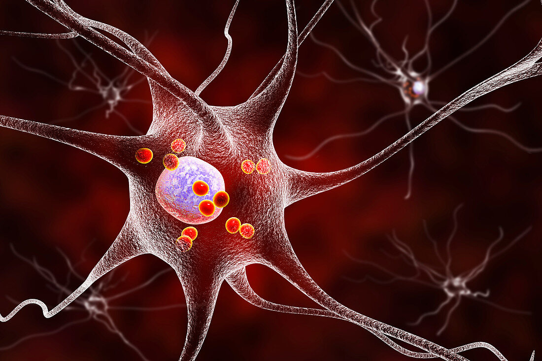Parkinson's disease nerve cells, illustration