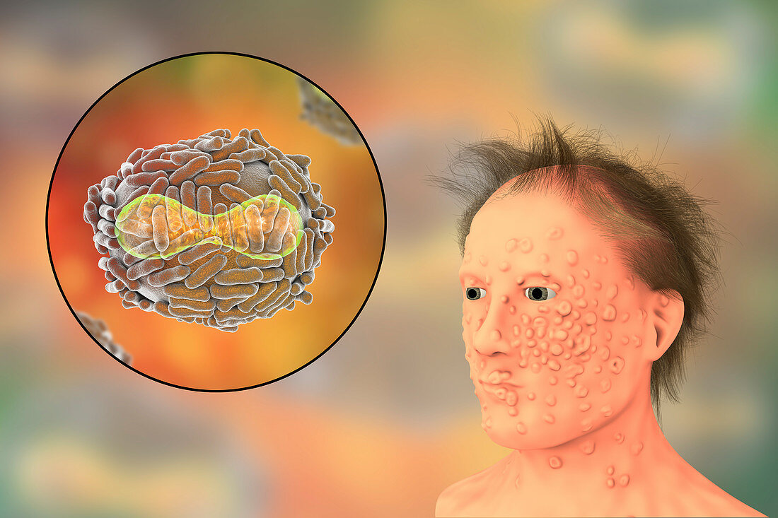 Smallpox virus and disease, illustration