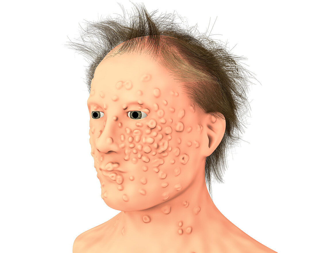 Patient with smallpox, illustration